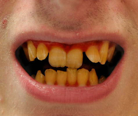 Worst Side Effects of Drinking Too Much Soda